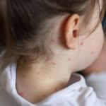 What are the symptoms of measles - and what should you do if you think your child is infected?