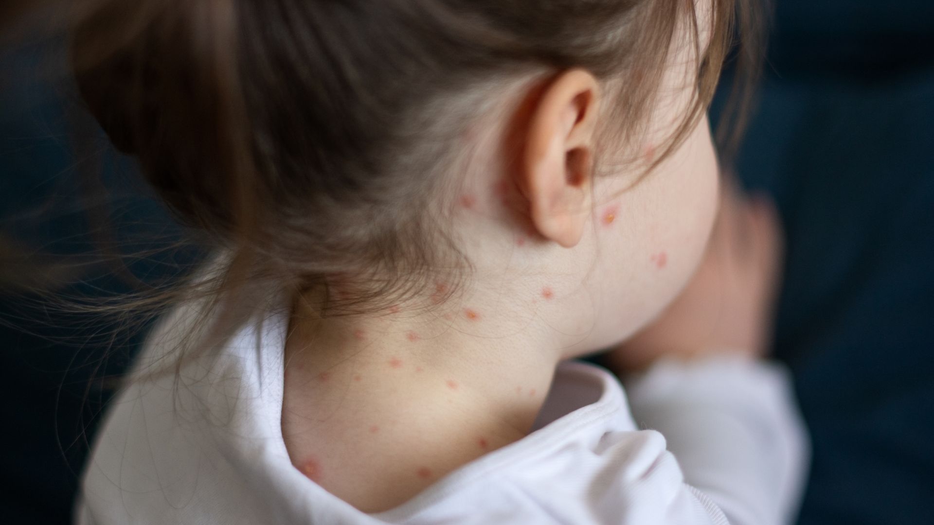 What are the symptoms of measles - and what should you do if you think your child is infected?
