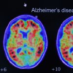 Simple at-home test can predict Alzheimer's risk, says study
