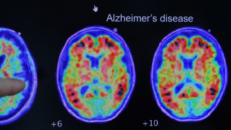 Simple at-home test can predict Alzheimer's risk, says study