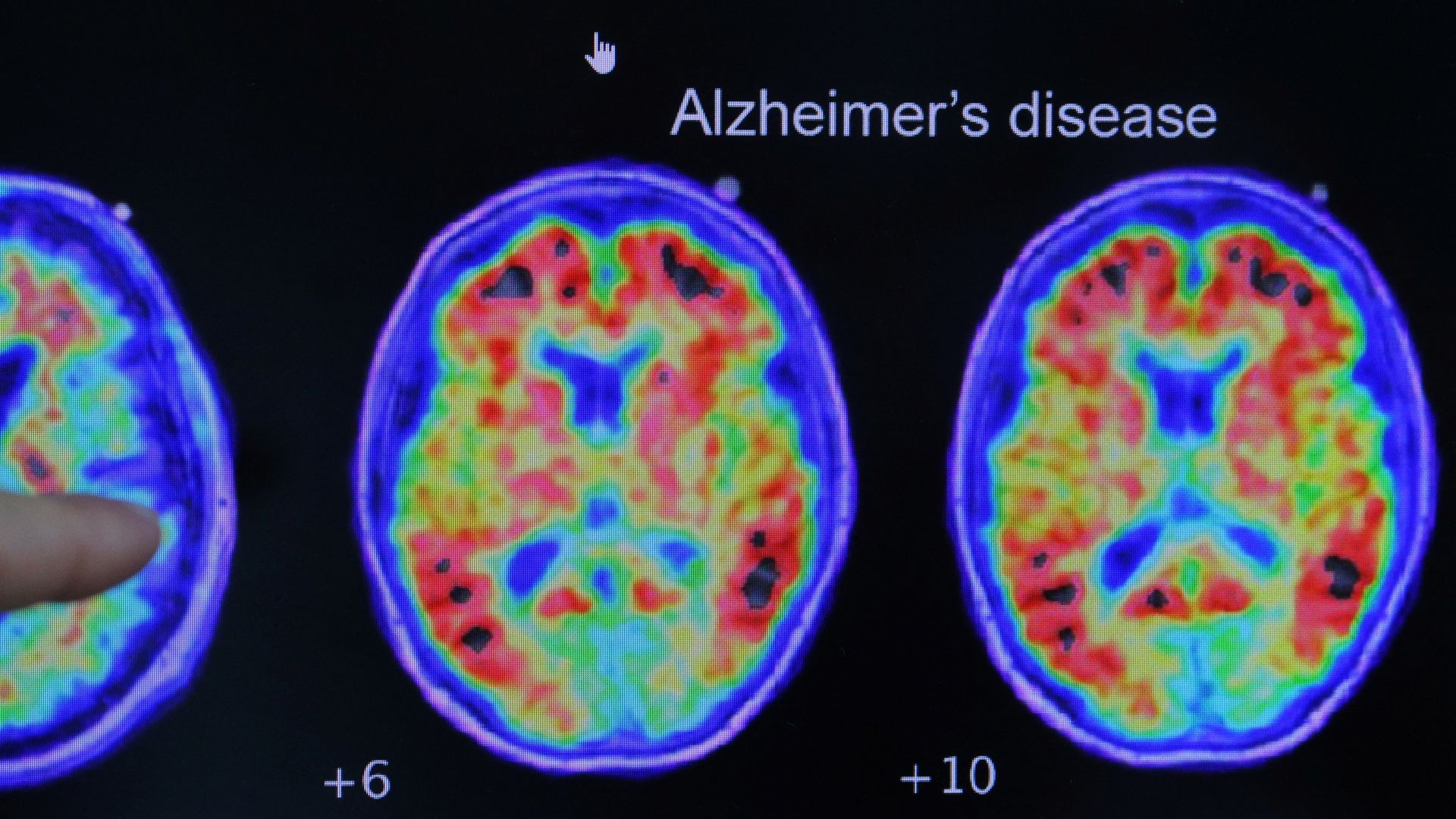 Simple at-home test can predict Alzheimer's risk, says study
